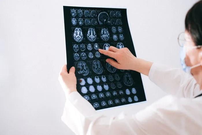 Radiólogo señalando un escáner cerebral en un negatoscopio