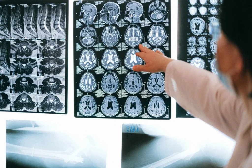 Médico señalando con el dedo imágenes de resonancia magnética cerebral en un negatoscopio