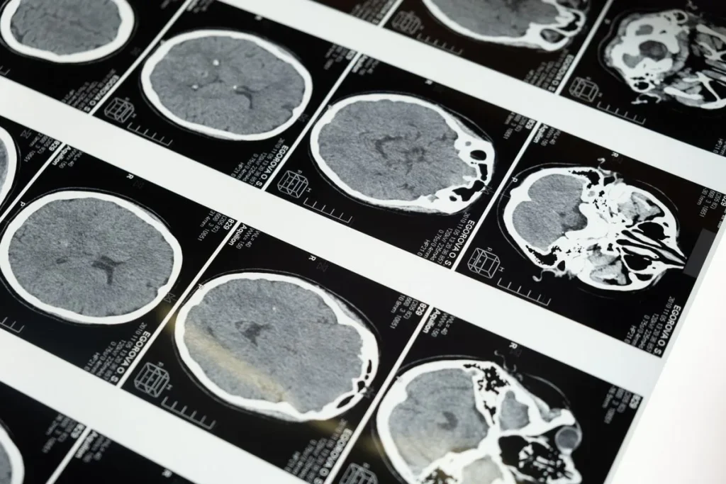 Radiografías de TAC cerebral sobre una mesa de diagnóstico