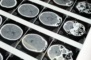 Radiografías de TAC cerebral sobre una mesa de diagnóstico